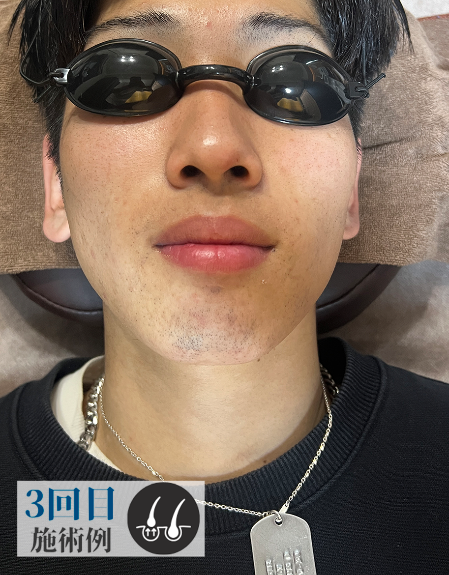 Aさん髭脱毛（After）