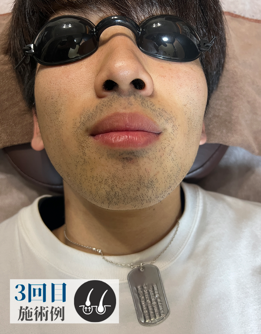 Aさん髭脱毛（Before）