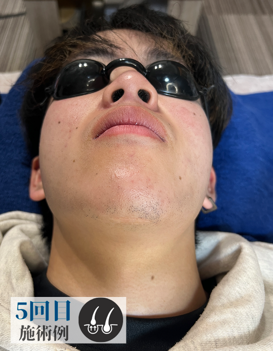Bさん髭脱毛（After）