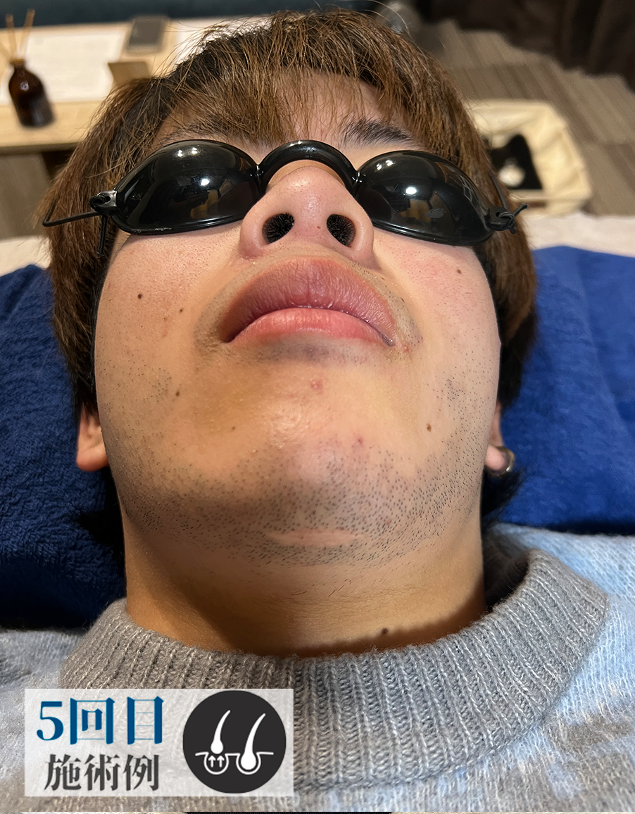 Bさん髭脱毛（Before）