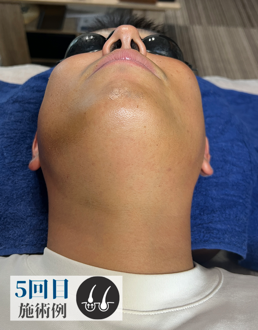 Cさん髭脱毛（After）