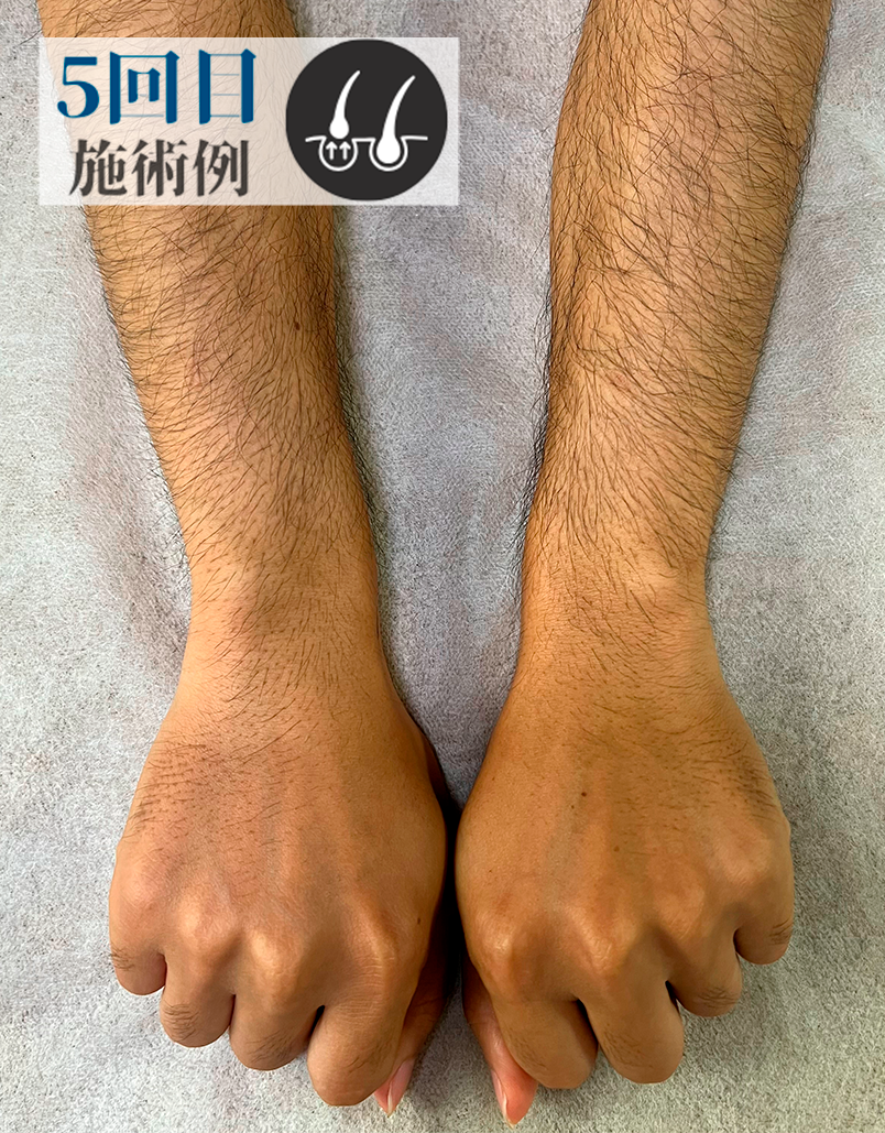 Aさん腕脱毛（Before）