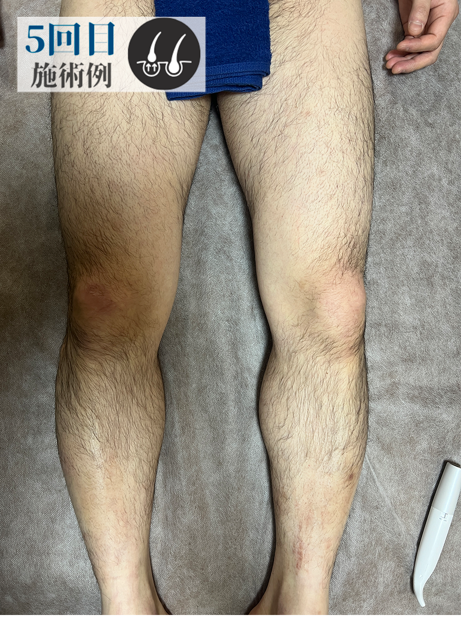 Aさん脚脱毛（Before）