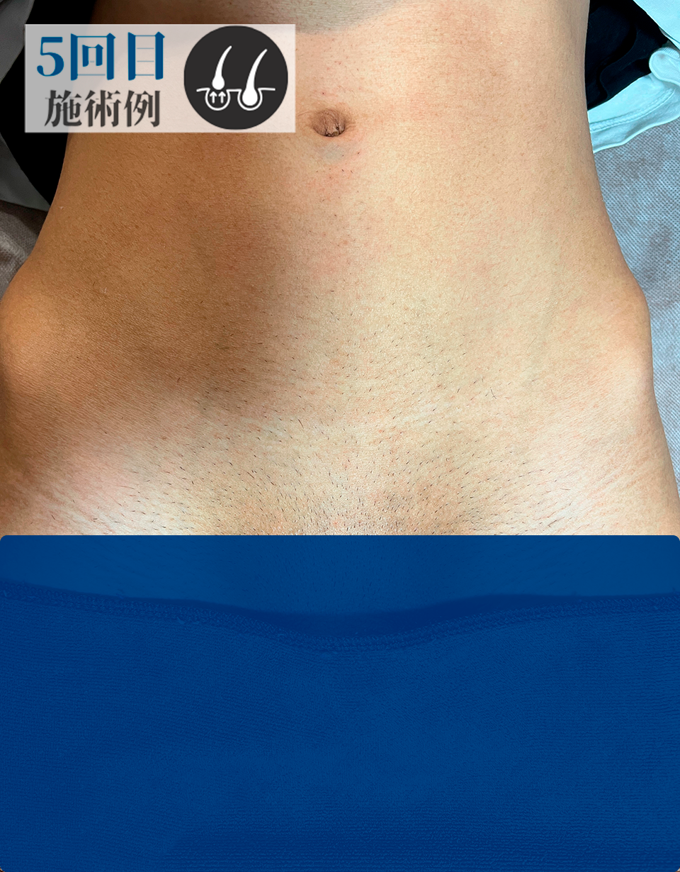 AさんVライン脱毛（Before）