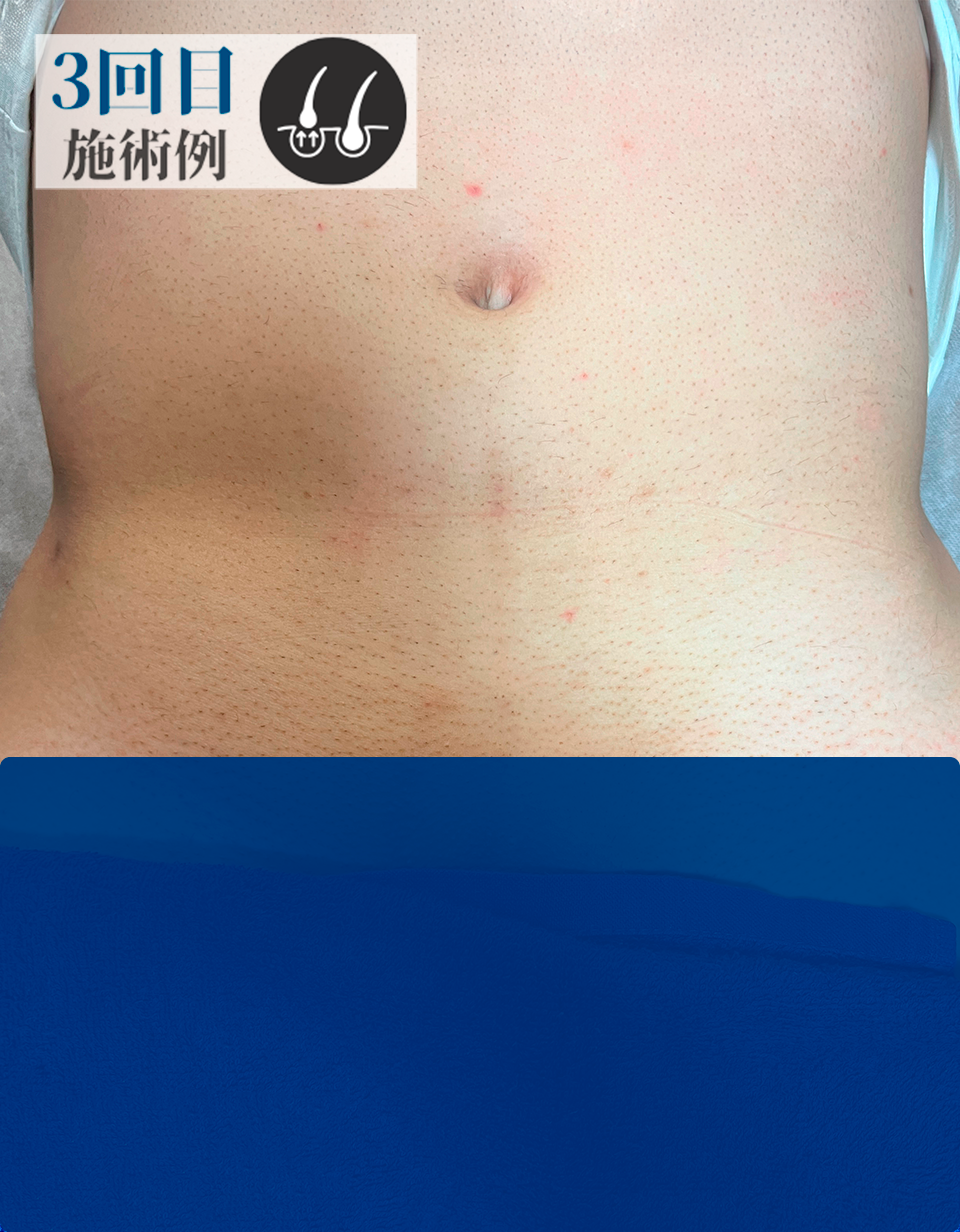 BさんVライン脱毛（After）