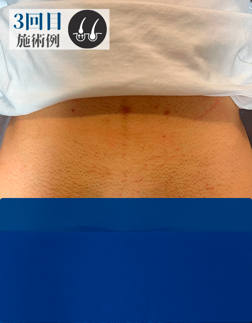 BさんVライン脱毛（Before）