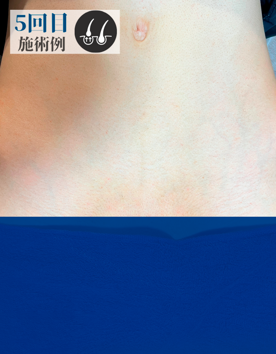 CさんVライン脱毛（After）