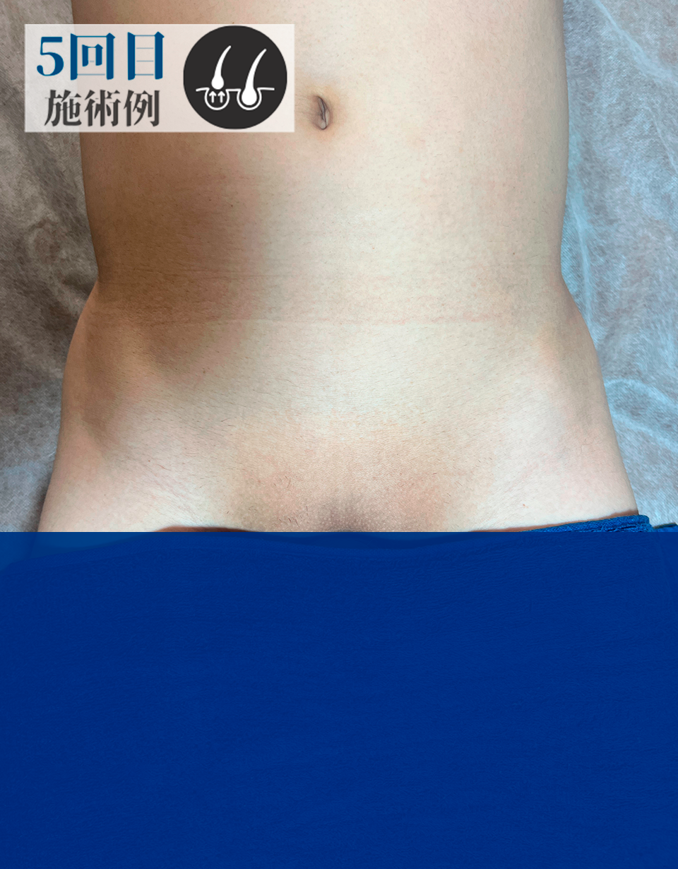 DさんVライン脱毛（After）