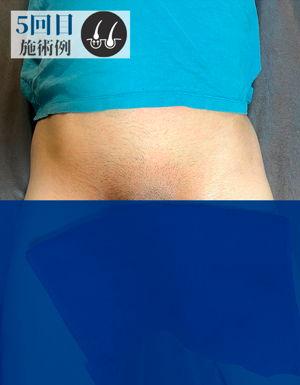 DさんVライン脱毛（Before）